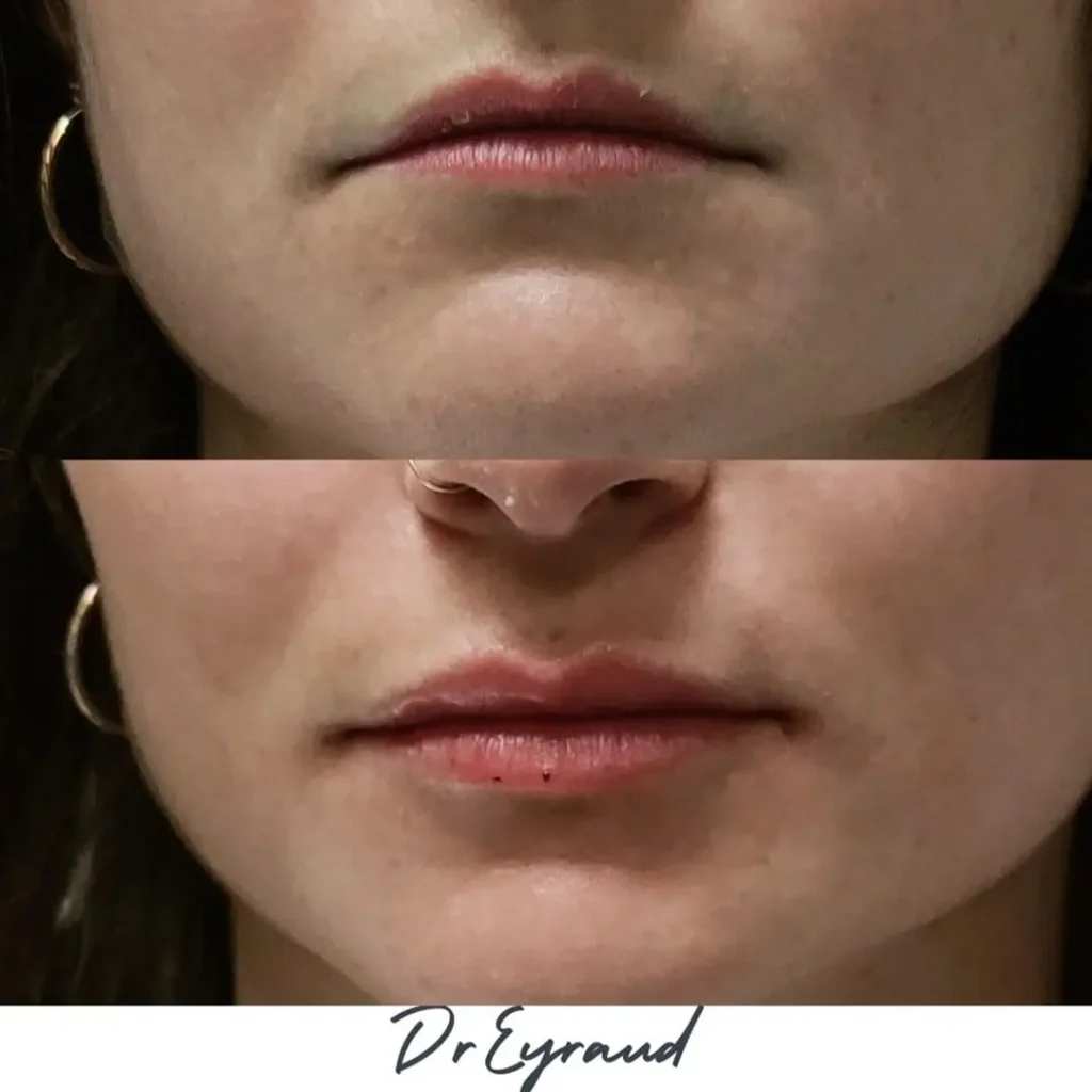 Avant et après une injection de Botox au visage (lèvres) à Orléans par le Dr Eyraud